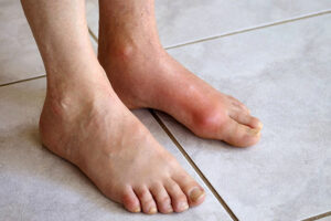 Triệu Chứng Ở Bàn Chân Của Bệnh Gout
