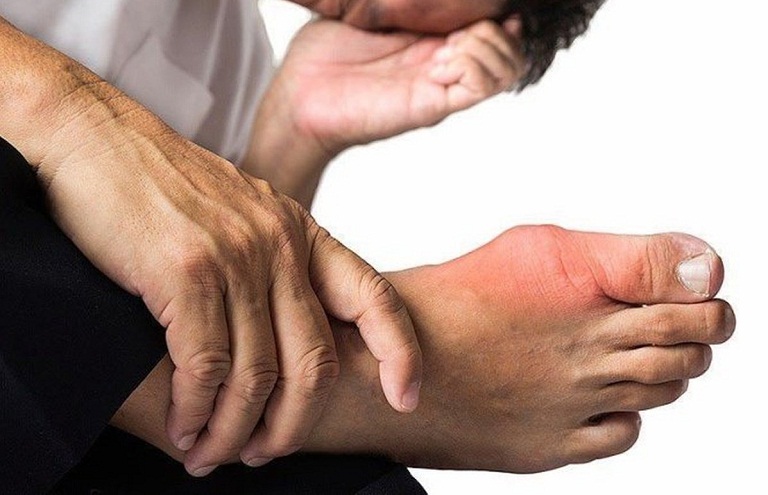 Stress có làm nặng gout không?