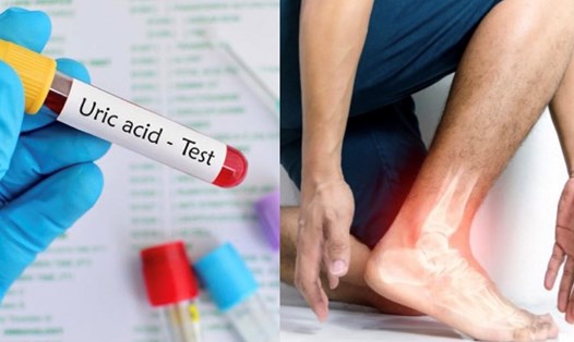 Gout có cần sinh thiết không?
