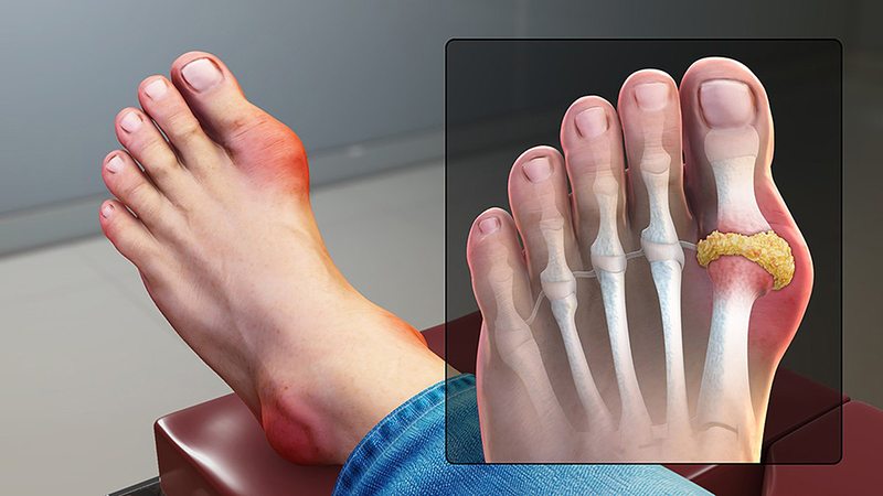Bệnh gout có cần chụp X-quang không?