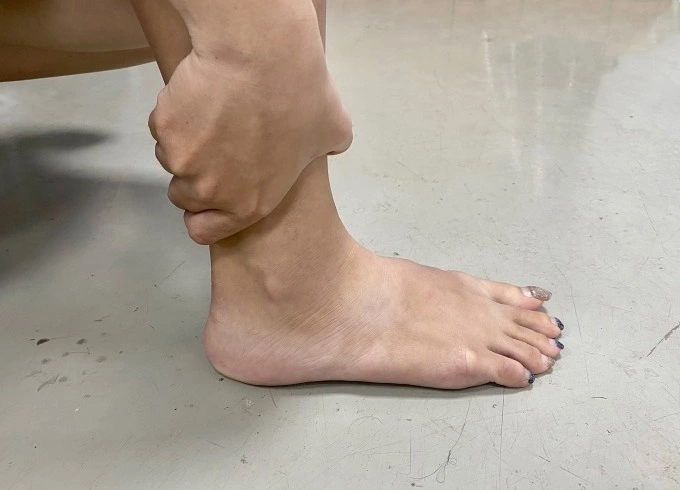 Gout Có Gây Sưng Mắt Cá Chân Không