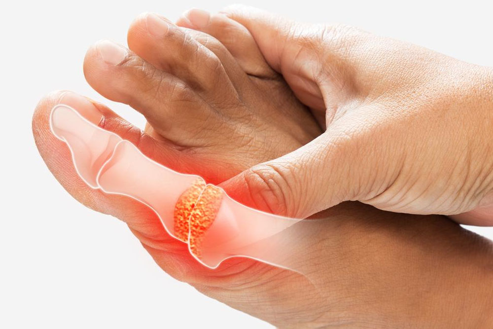 Gout Có Dẫn Tới Tàn Phế Không