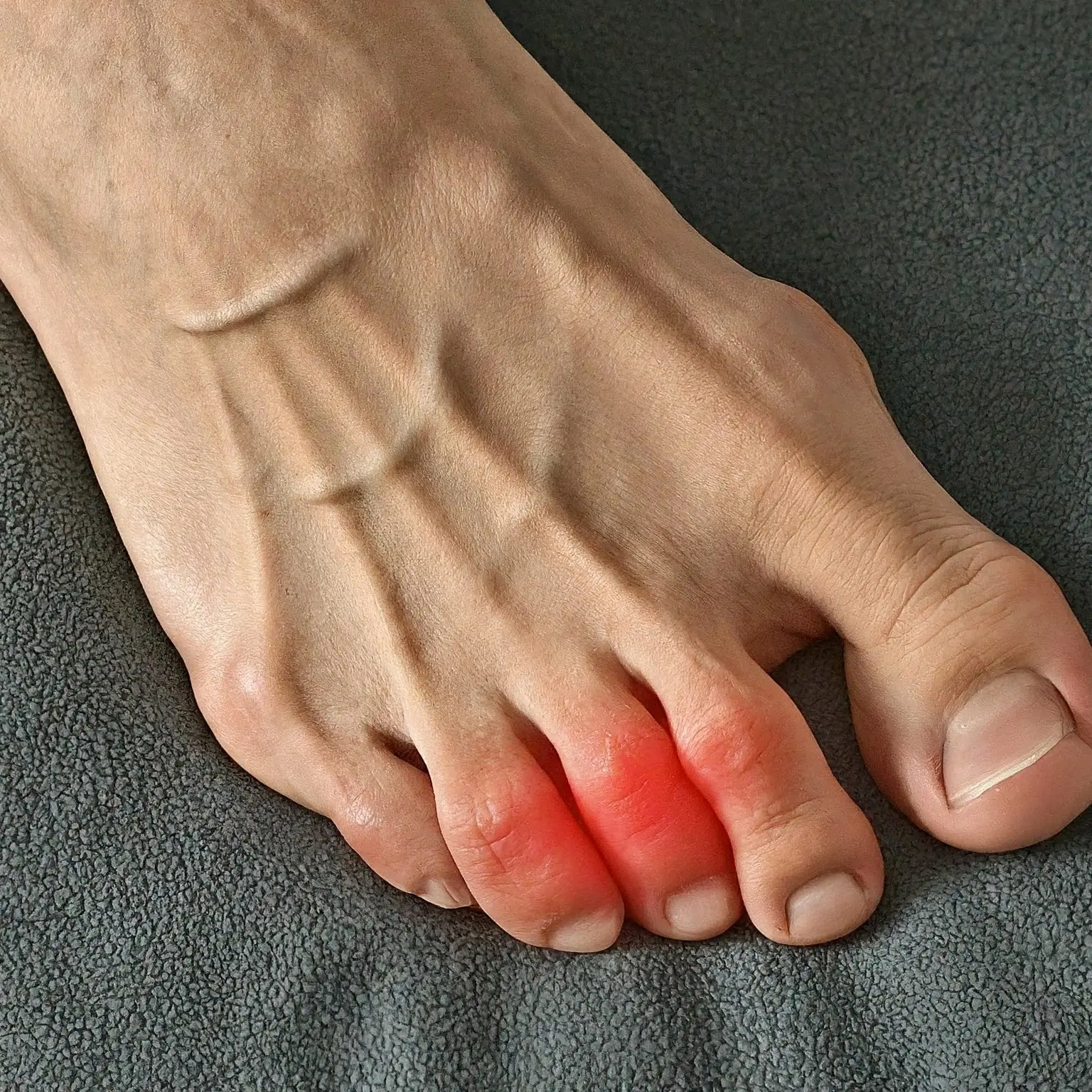 Bệnh Gout Có Dấu Hiệu Gì