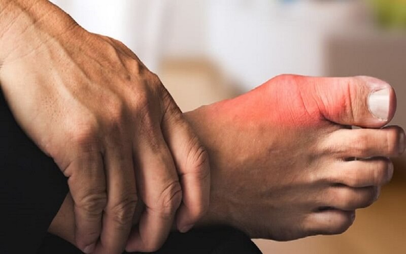 Điều Trị Gout Như Thế Nào