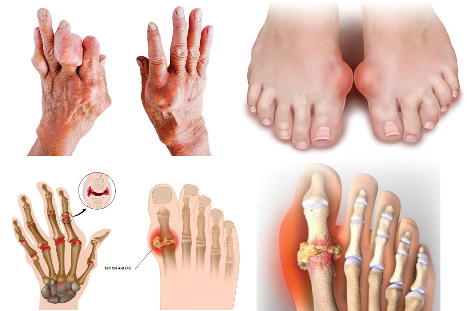 Gout Gây Biến Dạng Ngón Tay