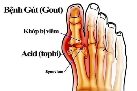 Hạt tophi là biến chứng nặng của bệnh gout