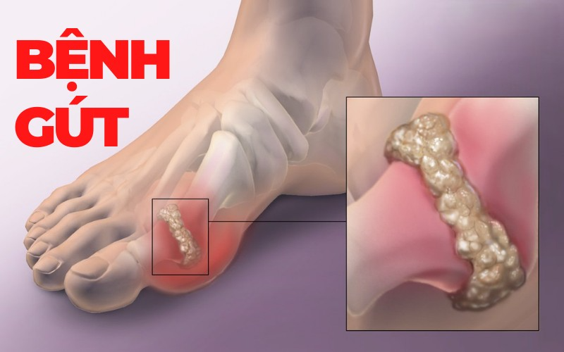 Nguyên nhân gây ra bệnh gút là gì?