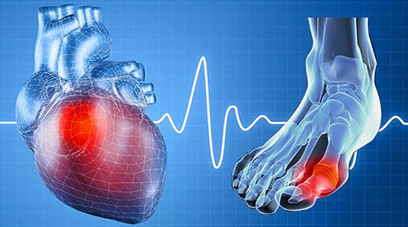 Gout ảnh hưởng đến tim như thế nào?