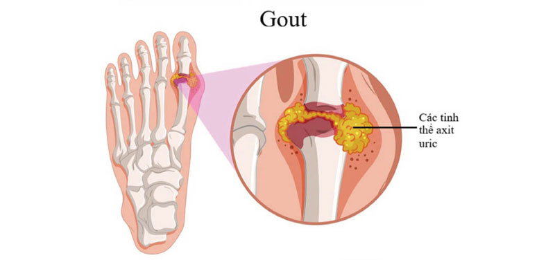 Rối loạn chuyển hóa gây gout như thế nào?