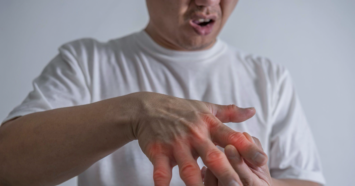 Vì sao gout dễ tái phát nhiều lần