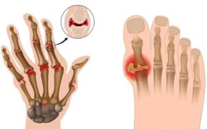 câu hỏi gout có tự khỏi không