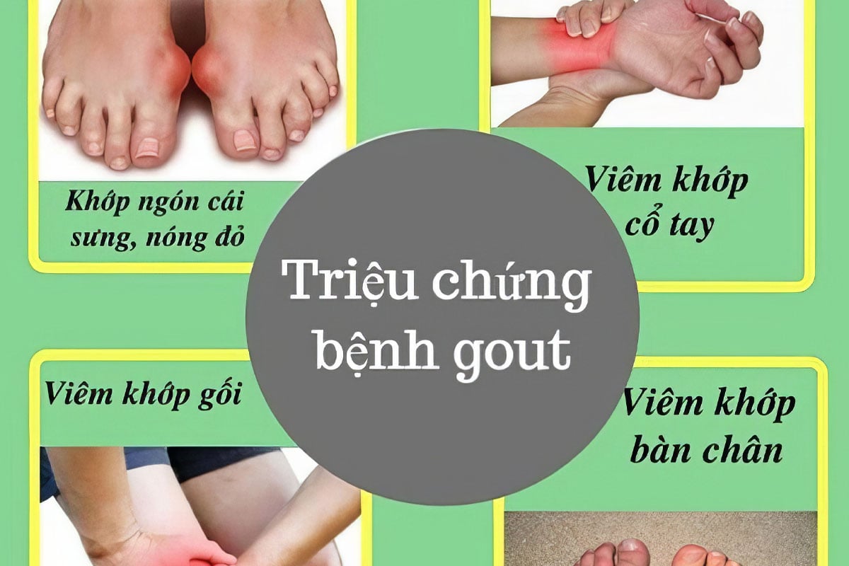 các dấu hiệu nhận biết gout sớm